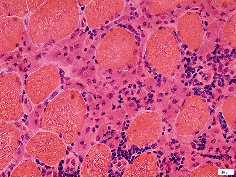Image result for Myofasciitis