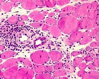 Polymyositis