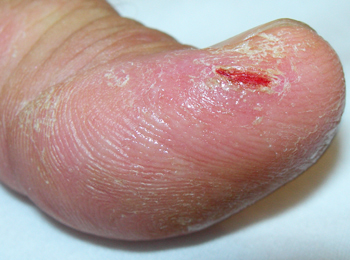 Why does dermatomyositis produce a skin rash?