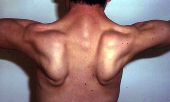 Symptoms of steroid myopathy