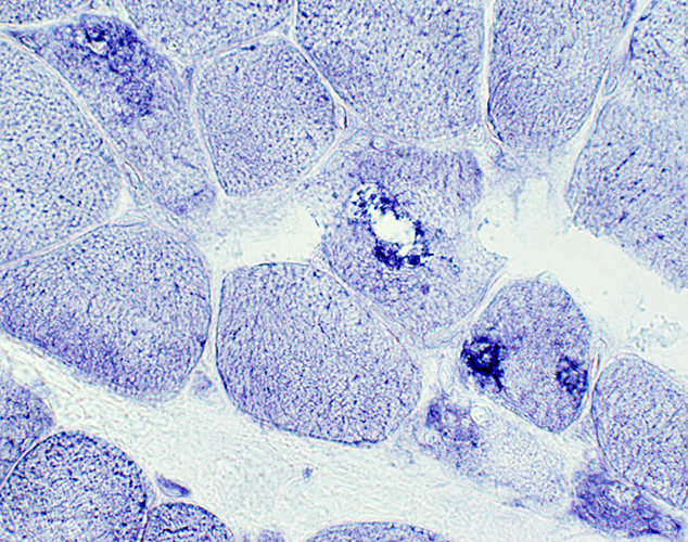 Cystinosis