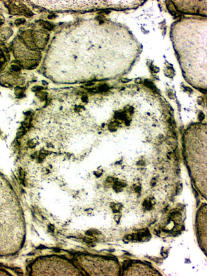Necrosis: MHC-I on phagocytic cells