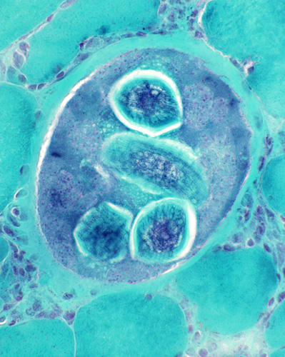 Trichinosis - Acute