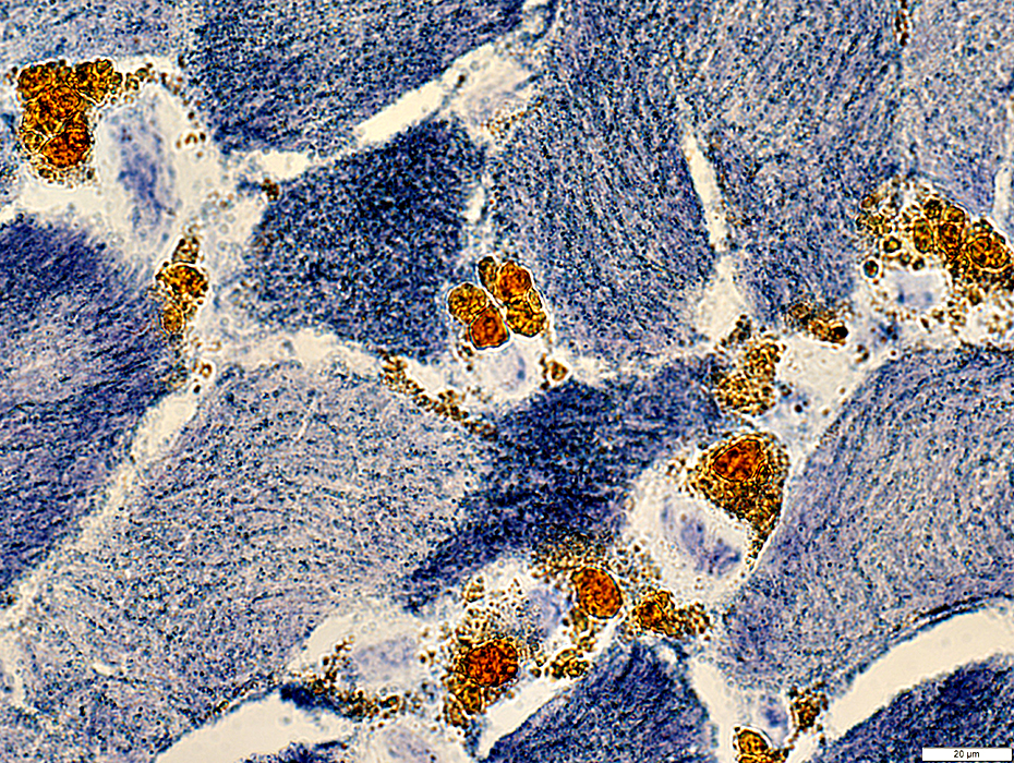 Hemosiderin