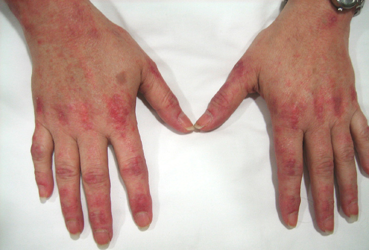 myositis skin rash