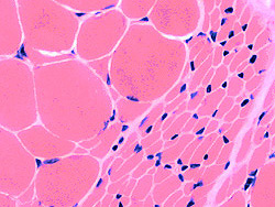 muscle atrophy histology